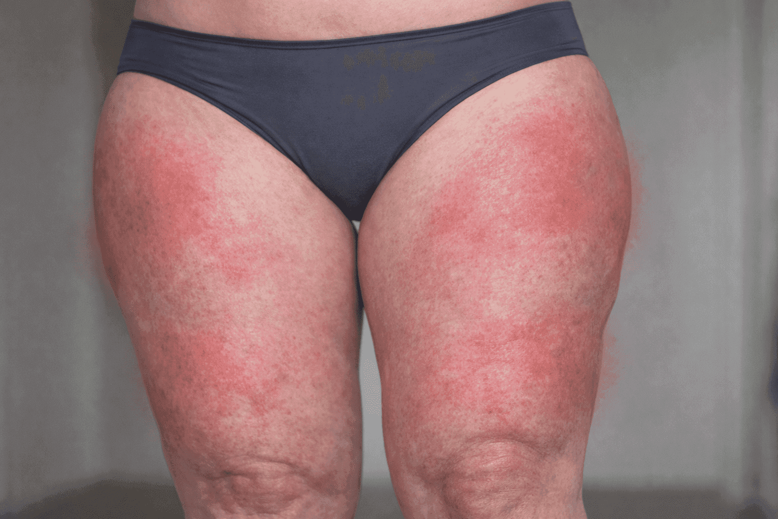 Lipedema: cos’è, sintomi e come gestirlo con alimentazione e attività fisica